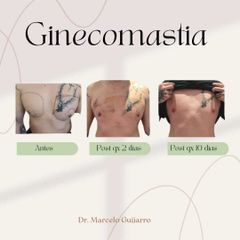 Ginecomastia - Dr. Marcelo Federico Guijarro