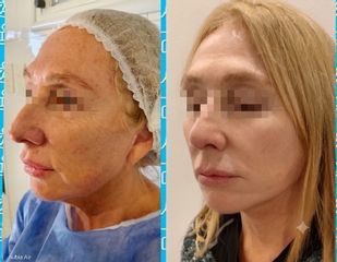 Lifting Facial - Dr. Marcelo Federico Guijarro