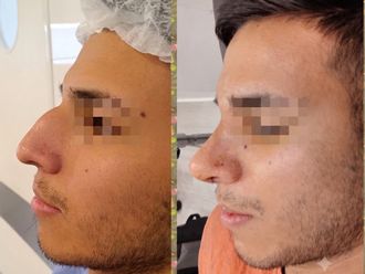 Rinoplastia antes y después - 880178