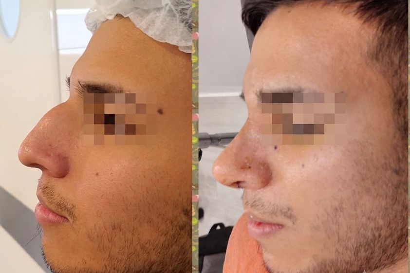 Rinoplastia antes y después - 880178