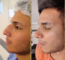 Rinoplastia - Dr. Marcelo Federico Guijarro