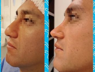 Rinoplastia antes y después - 880179