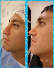 Rinoplastia - Dr. Marcelo Federico Guijarro