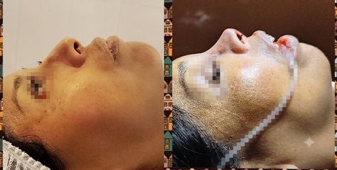Rinoplastia - Dr. Marcelo Federico Guijarro