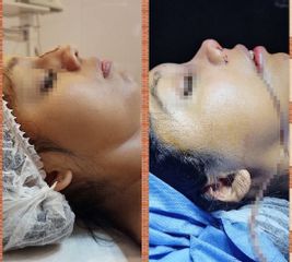 Rinoplastia - Dr. Marcelo Federico Guijarro