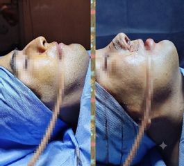 Rinoplastia - Dr. Marcelo Federico Guijarro