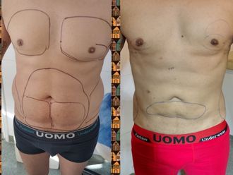 Abdominoplastía antes y después - 880183