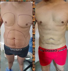 Marcación Abdominal - Dr. Marcelo Federico Guijarro