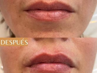 Relleno de labios antes y después - 873997