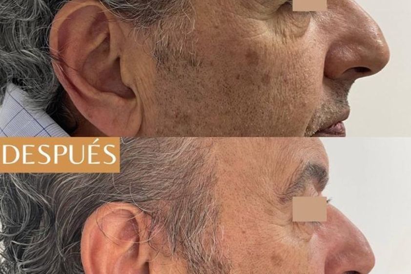 Eliminación ojeras antes y después - 873998