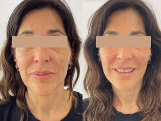 Rejuvenecimiento facial antes y después - 874002