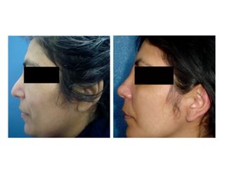 Rinoplastia