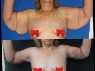 Braquioplastia