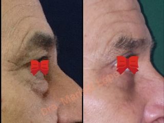 Blefaroplastia