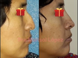 Rinoplastia