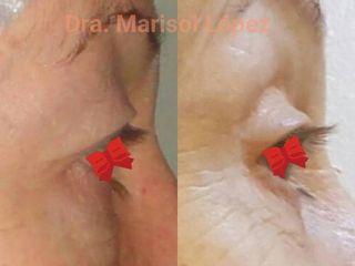 Blefaroplastia Dra. Marisol López