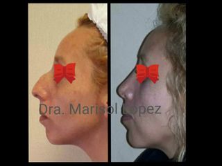 Rinoplastia