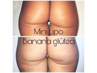 Mini Lipo Dr. Martin Salas