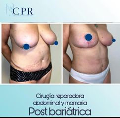 Abdominoplastia - Dr. Martín Salas