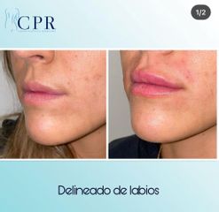 Relleno de labios - Dr. Martín Salas