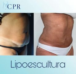 Lipoescultura - Dr. Martín Salas