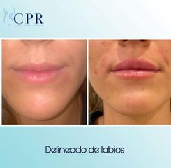 Relleno de labios - Dr. Martín Salas