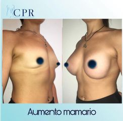 Aumento mamas - Dr. Martín Salas