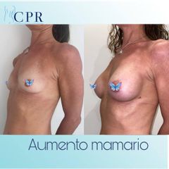 Aumento mamas - Dr. Martín Salas