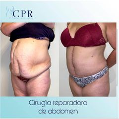 Abdominoplastia - Dr. Martín Salas