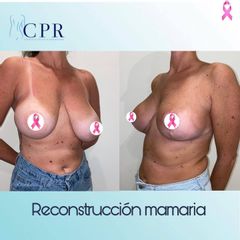 Reconstrucción mamaria - Dr. Martín Salas