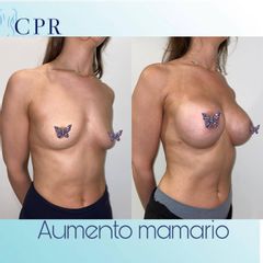 Aumento mamas  - Dr. Martín Salas