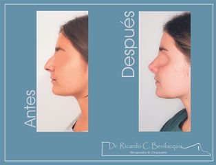 Rinoplastia - Dr. Ricardo C. Bevilacqua