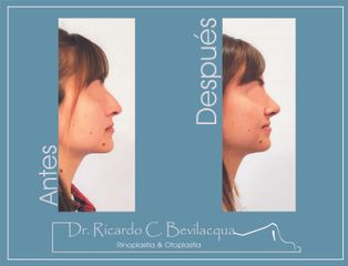 Rinoplastia - Dr. Ricardo C. Bevilacqua