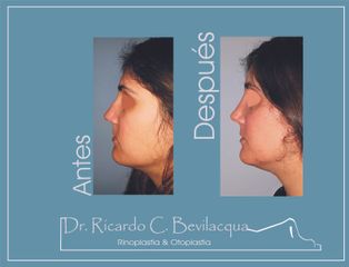 Rinoplastia - Dr. Ricardo C. Bevilacqua