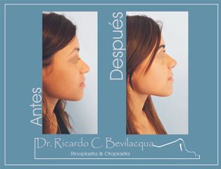 Rinoplastia - Dr. Ricardo C. Bevilacqua