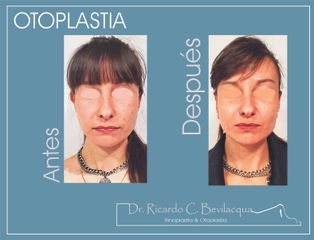 Otoplastia - Dr. Ricardo C. Bevilacqua