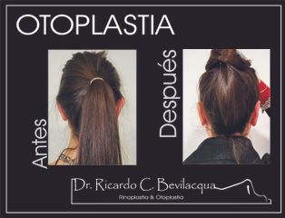 Otoplastia - Dr. Ricardo C. Bevilacqua