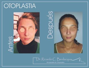 Otoplastia - Dr. Ricardo C. Bevilacqua