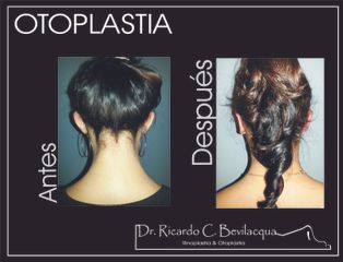 Otoplastia - Dr. Ricardo C. Bevilacqua