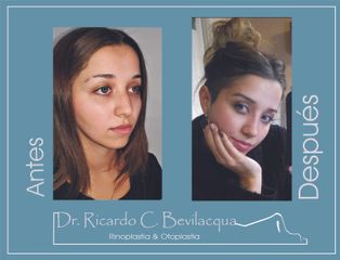 Rinoplastia - Dr. Ricardo C. Bevilacqua