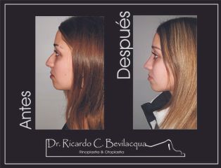 Rinoplastia - Dr. Ricardo C. Bevilacqua