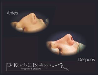 Rinoplastia - Dr. Ricardo C. Bevilacqua