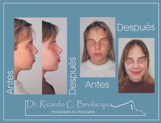 Rinoplastia - Dr. Ricardo C. Bevilacqua