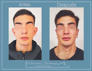 Otoplastia - Dr. Ricardo C. Bevilacqua