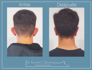 Otoplastia - Dr. Ricardo C. Bevilacqua