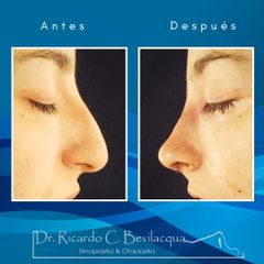 Rinoplastia - Dr. Ricardo C. Bevilacqua