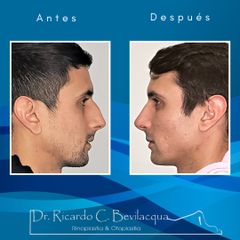 Rinoplastia - Dr. Ricardo C. Bevilacqua