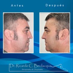 Rinoplastia - Dr. Ricardo C. Bevilacqua