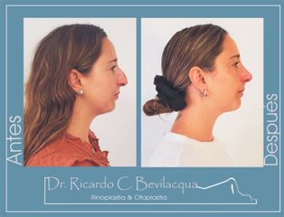 Rinoplastia - Dr. Ricardo C. Bevilacqua