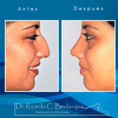 Rinoplastia - Dr. Ricardo C. Bevilacqua